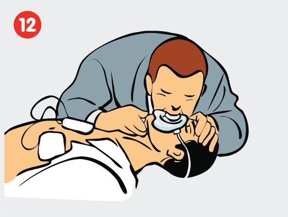 Gaivinimo žingsnis – dirbtinis kvėpavimas su kauke