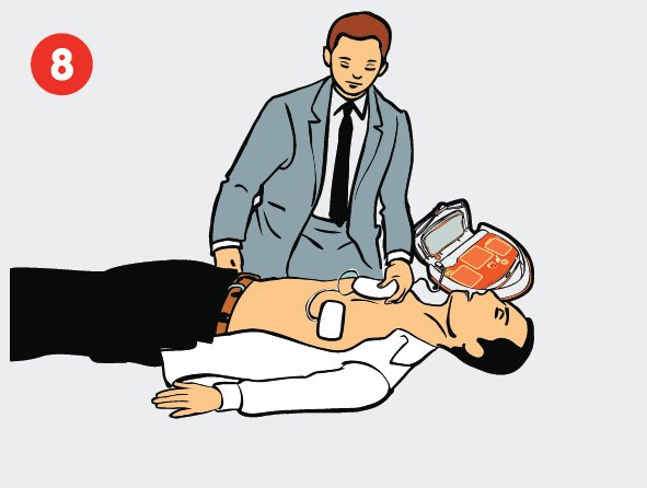 8 žingsnis – elektrodų prijungimas prie paciento